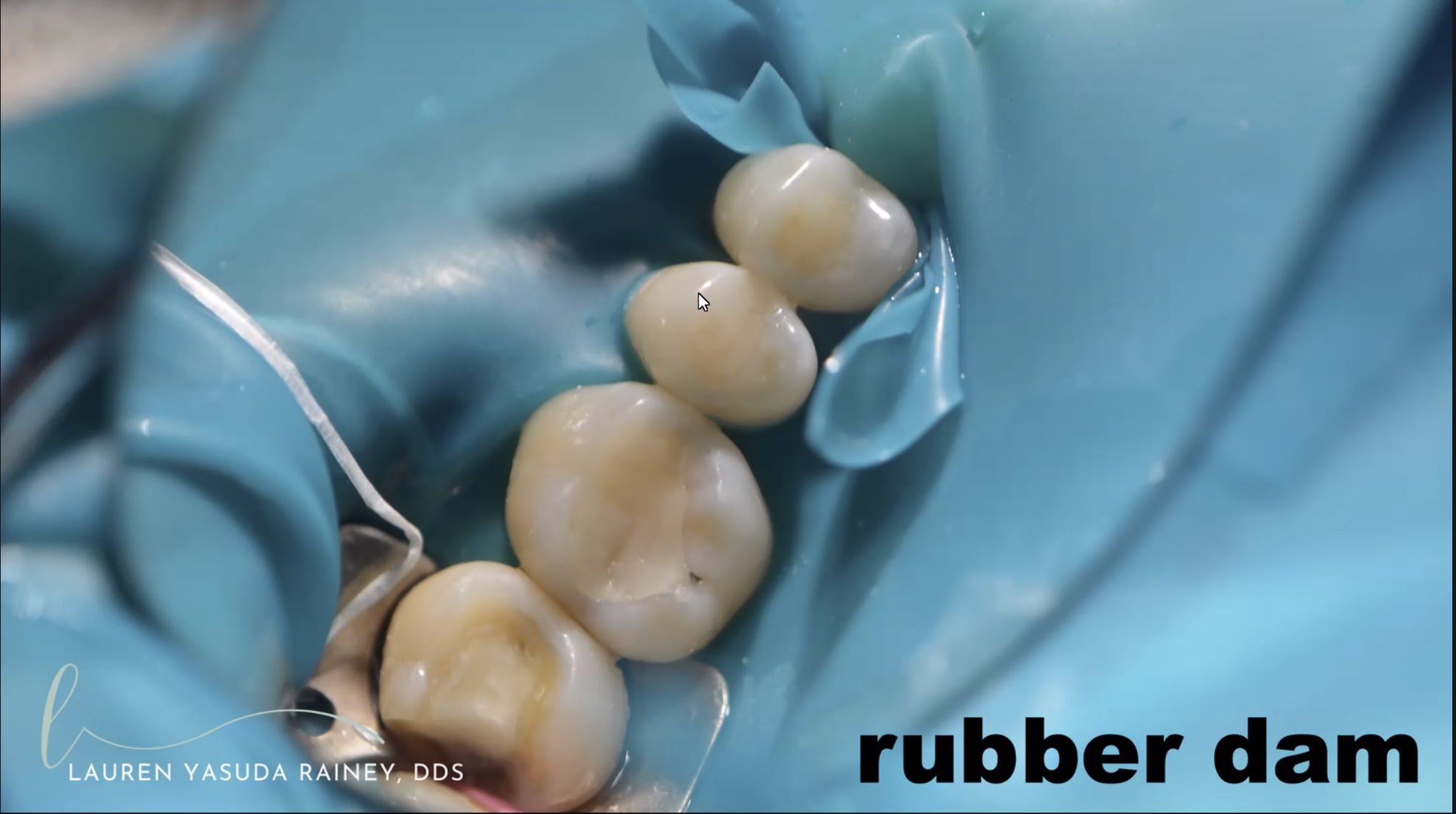 CROWN ZIRCONIA BRUXIR